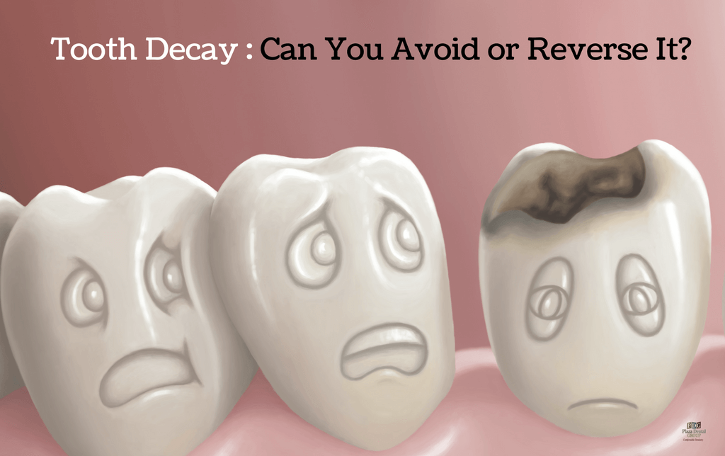 tooth-decay-can-you-avoid-or-reverse-it.png